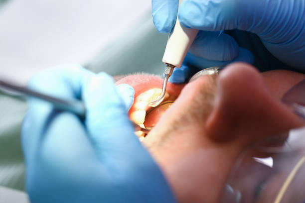 Best Emergency Tooth Extraction in Booneville, MS